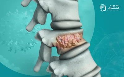 أورام العمود الفقري | أنواعها وأعراضها وسُبل علاجها