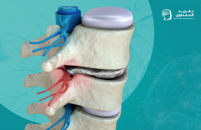 علاج ضيق القناة العصبية