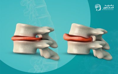 ما درجات الانزلاق الغضروفي؟ وما أشدهم خطورة؟