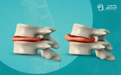 ما درجات الانزلاق الغضروفي؟ وما أشدهم خطورة؟