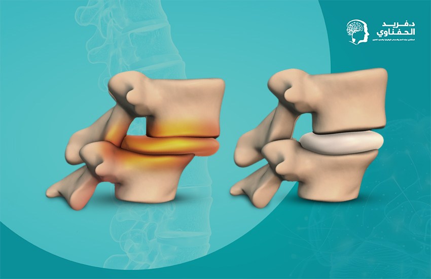 درجات-تزحزح-الفقرات درجات تزحزح الفقرات