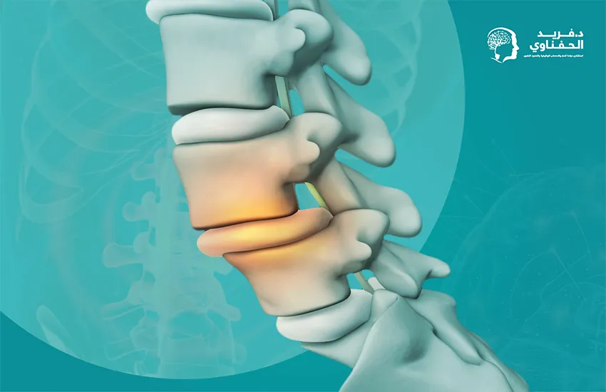علاج تزحزح الفقرات