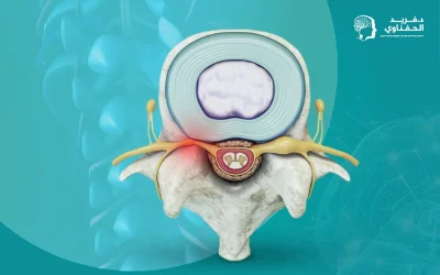 ضيق القناة العصبية | أعراضه وأسبابه وسُبل العلاج
