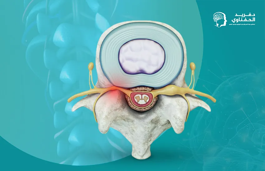 ضيق-القناة-العصبية ضيق القناة العصبية